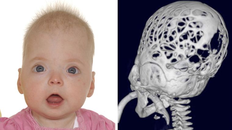 The ability to sequence whole exomes and genomes of individual people has revolutionised our ability to explore the full spectrum of genetic mutations causing serious human diseases. Working closely with the craniofacial teams based in Oxford and other UK units, we specialise in the application of these methods to children born with a serious malformation of the skull termed craniosynostosis.