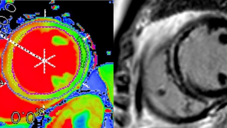 Black and white and colour MRI images of the heart