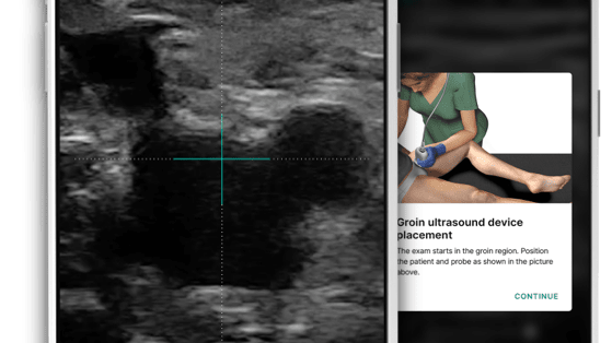 Composite image showing two mobile phone screens, one with ultrasound image, and one showing drawings of a female healthcare practitioner placing tool on patient leg