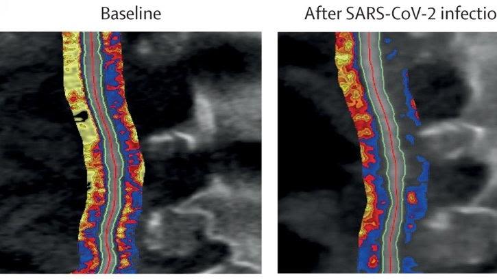 Photo composite showing a comparison of Peri-imap pvat images at baseline, and after covid infection. The delineation in the covid image is much less clear.